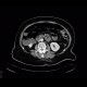 Ileus, bowel ischemia: CT - Computed tomography